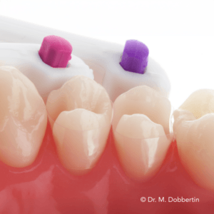 mise en situation dentaire rose – BANDES MATRICIELLES SAFEMATRIX® CLEAR CONTOUR